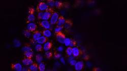Israeli researchers find "potential hope" for some pancreatic cancer patients. National Cancer Institute
