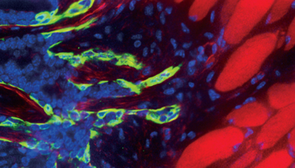Surprising Roles for Cell Adhesion in Cancer Metastasis